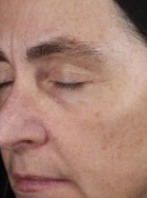 Week 12 of second woman after application of Mircale Set.